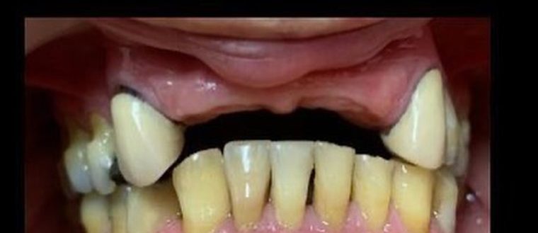 Antes: faltan dientes superiores